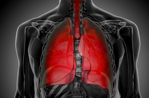 mesothelioma lymphangitic